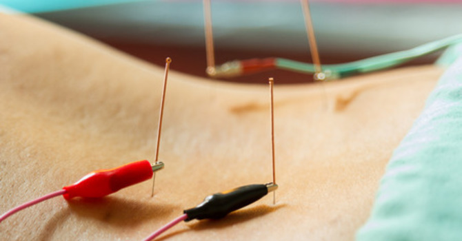 Acupuncture